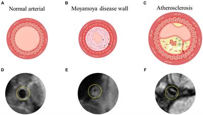 High-resolution magnetic resonance vessel wall imaging provides new insights into Moyamoya disease